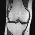 knee-mri-scan-front1